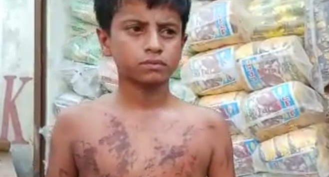 تيزاب جي بوتل ڦاٽڻ سبب 3 ڄڻا سڙي زخمي، اسپتال داخل