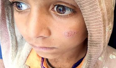 ڪاڇي ۾ ليشميناسز جي وبا، مفت علاج لاءِ ڪيمپ