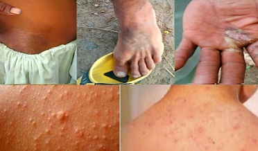 سوين ڳوٺاڻا خارش جي بيماري ۾ مبتلا، علاج جي اپيل