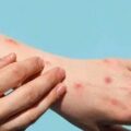 Monkeypox