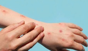 Monkeypox